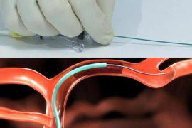 Un total de 2.100 persones pateixen un ictus cada any a Balears.